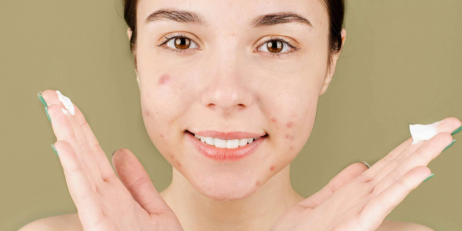 Rutina facial para piel acneica: Conoce todos los pasos