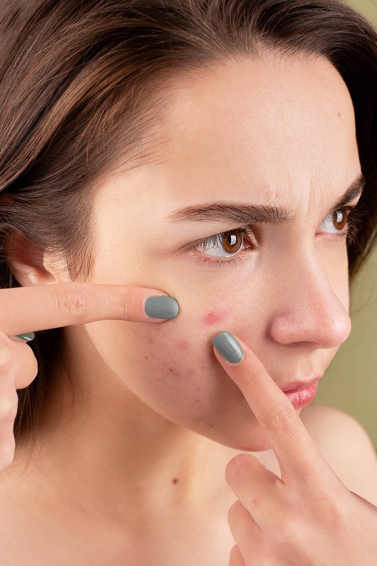 ¿Cómo eliminar marcas de acné?
